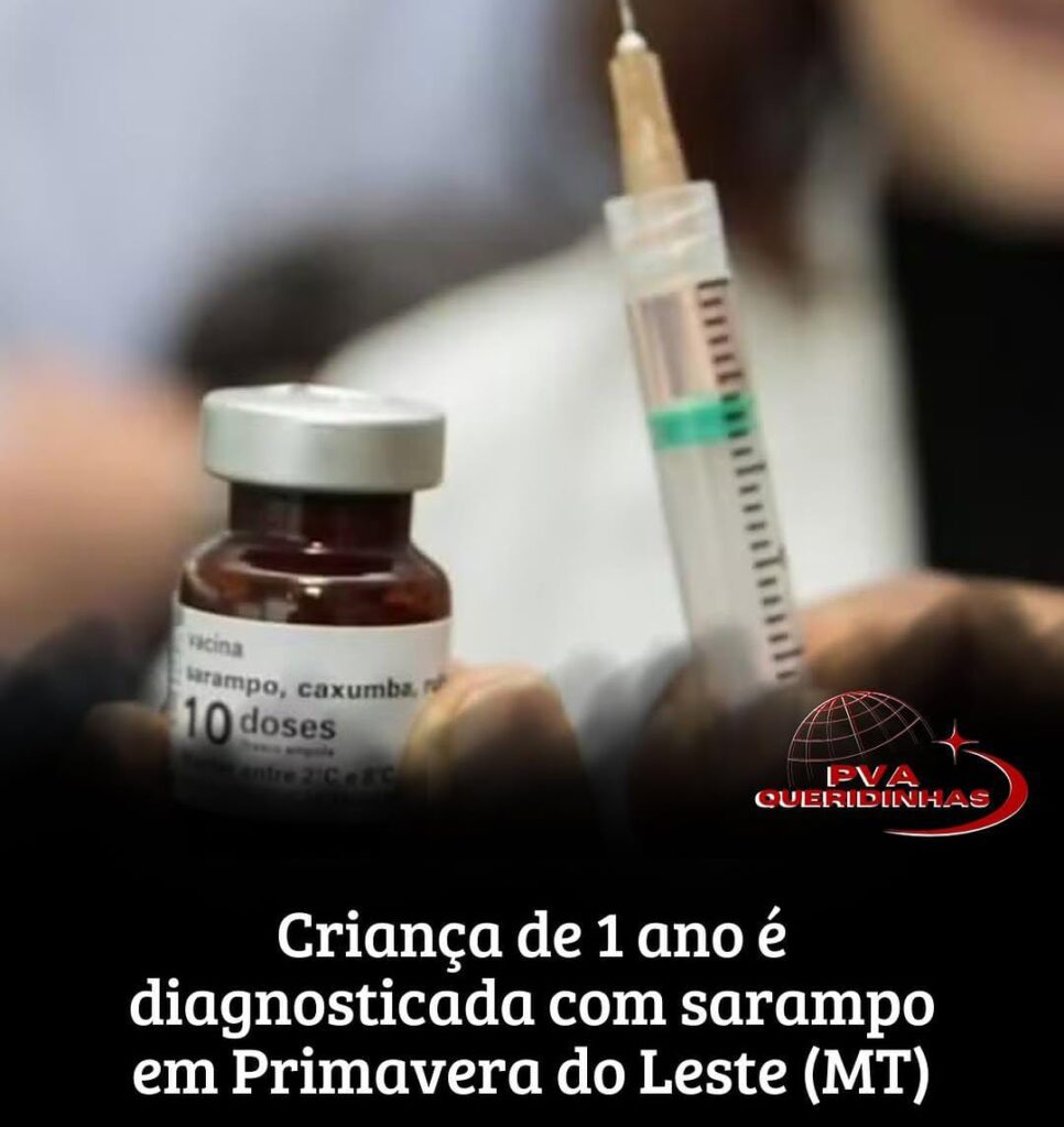 Sarampo em Primavera do Leste: sexto caso confirmado em criança