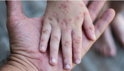 meningite em comunidades do interior de Mato Grosso em destaque